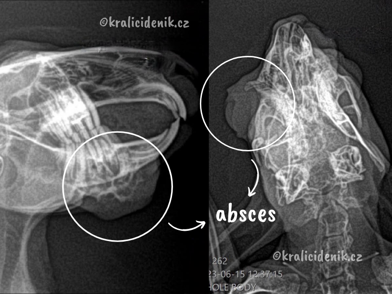 absces